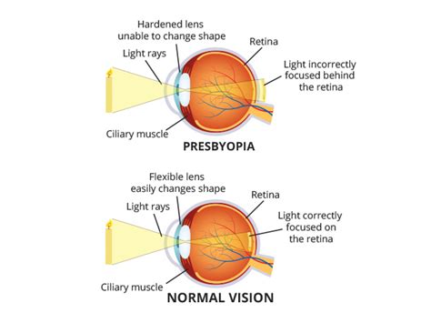 Presbyopia Symptoms + Treatments: Bausch + Lomb