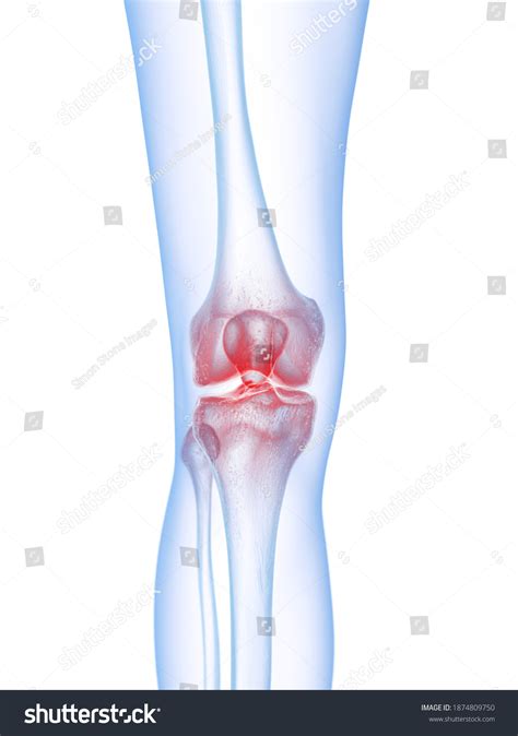 5,529 Knee Infection Images, Stock Photos & Vectors | Shutterstock