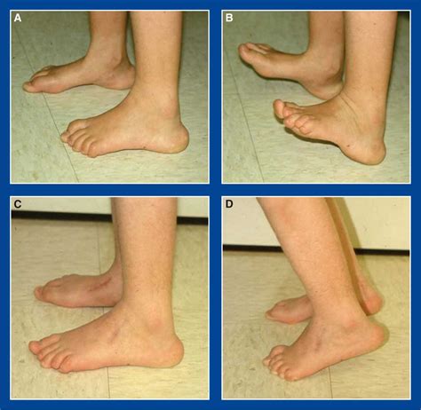 Foot and Ankle Deformities | Musculoskeletal Key