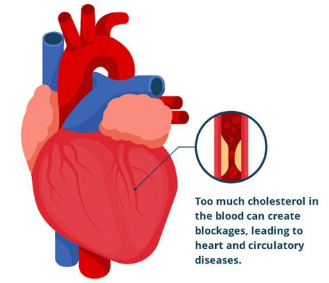 What is High Cholesterol? What is Atherosclerosis? | HEART UK