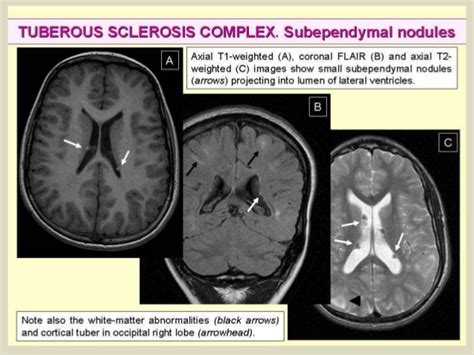 Tuberous sclerosis,what to know?