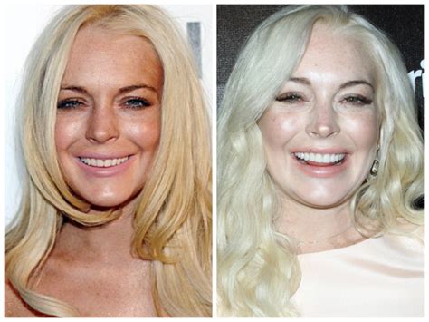 Celebrities with Veneers | My Porcelain Veneers