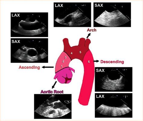 Vegetation On Aortic Valve Echocardiogram With Video