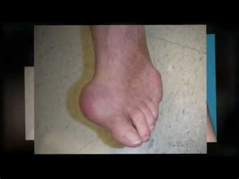 The 5-Second Trick For Symptoms of Gout in Ankle | Gout in Ankle