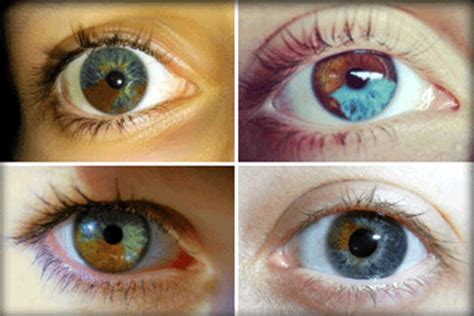 Sectoral Heterochromia: Condition Where One Part of Eye Is Different