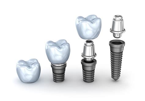 Average Cost of Dental Implants Columbia MD | Tooth Implant