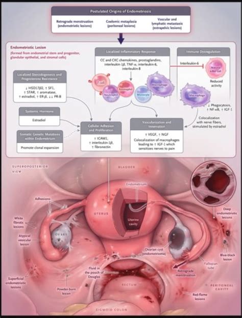 Treatment for Endometriosis - Philadelphia Homeopathic Clinic - Dr. Tsan