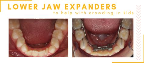 Lower Jaw Expander