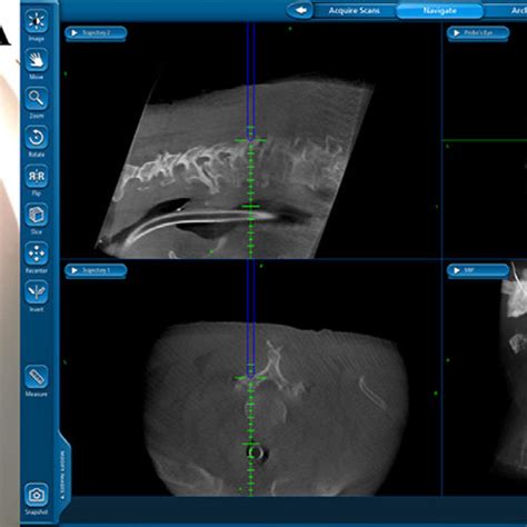 (A) Intraoperative O-arm surgical imaging system. (B) The... | Download ...