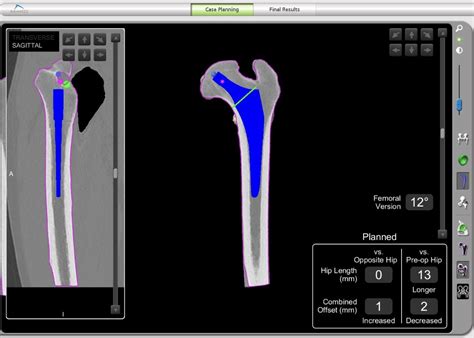 Robotic Hip Replacement | Leeds Joint Replacements