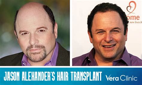 Jason Alexander's Hair Transplant: His Transformation and Insights