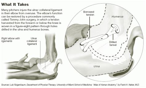Tommy John Surgery
