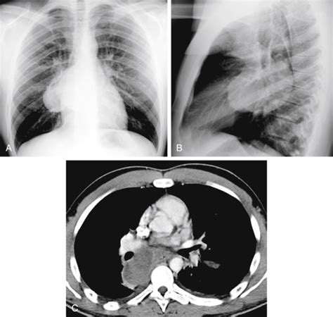 Middle Mediastinal Mass | Radiology Key