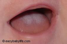 How to Get Rid of Oral Baby Thrush - 7 Home Remedies that Work Quickly ...