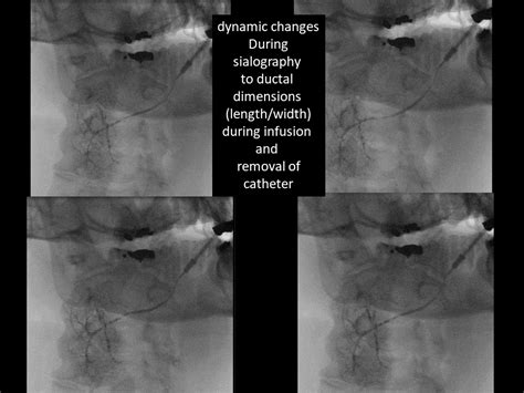 Submandibular Sialogram with Stricture Showing Dynamic Changes to Duct ...