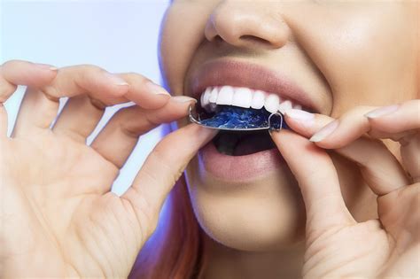 Removable or Permanent Retainer? - Charleston Orthodontics Powered By Smile Doctors