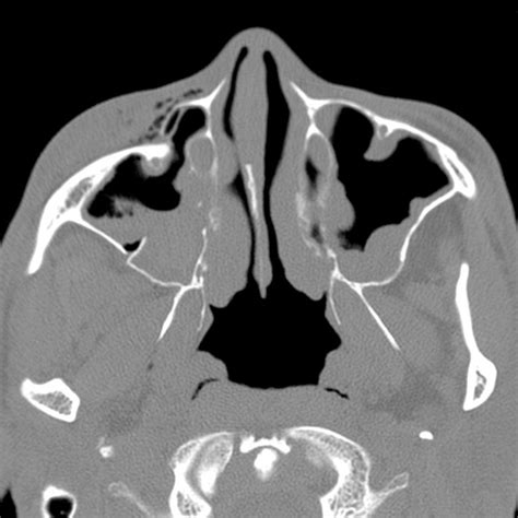 Zygomaticomaxillary Complex Fracture - RadNotes