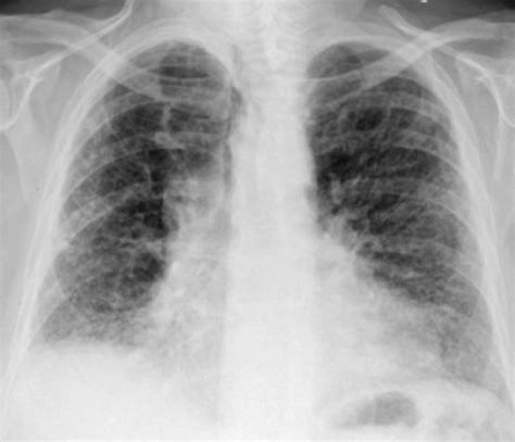 Interstitial lung disease - Life Expectancy, Prognosis, Treatment ...