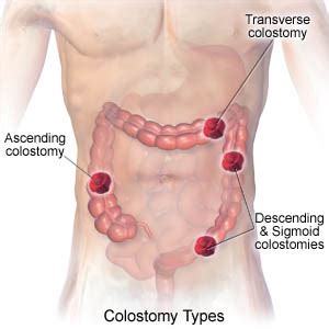 Open Colostomy Reversal (Aftercare Instructions) - Care Guide