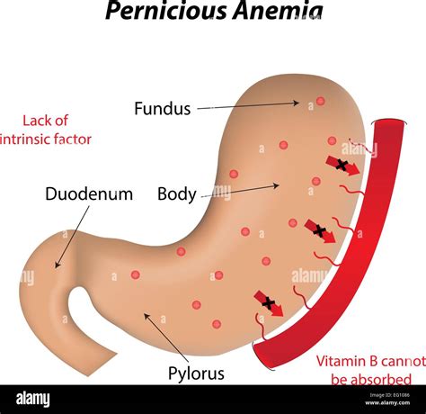 Pernicious Anemia Stock Vector Image & Art - Alamy