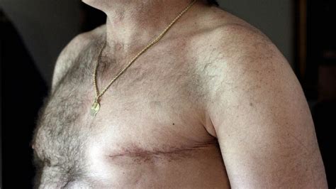 Double mastectomies for men with breast cancer on rise - CNN