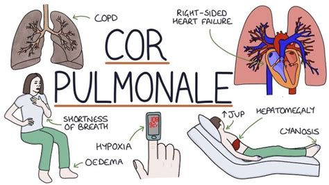 Cor pulmonale: causes, symptoms and treatment - Hayzed Magazine