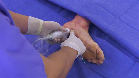 Plantar Fasciitis Surgery Pictures - Plant Ideas