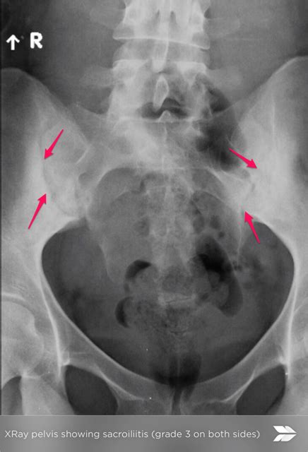 Sacroiliac joint X-rays in diagnosis of Ankylosing Spondylitis