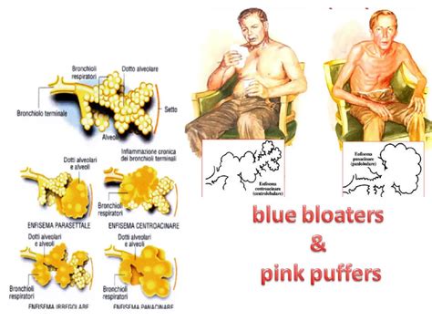 Surichinmoi Ein Risiko eingehen Beschäftigung copd pink puffer vs blue bloater Torrent Passagier ...