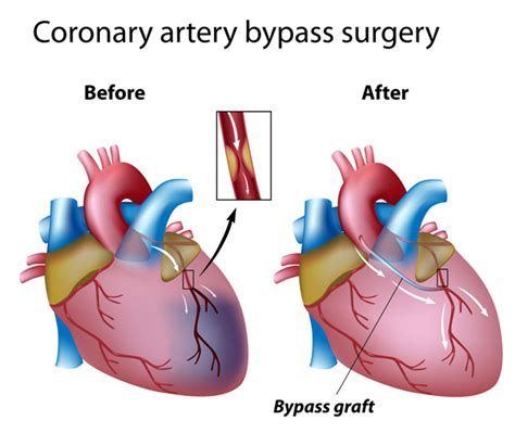 Coronary Artery Bypass Graft Surgery Overview