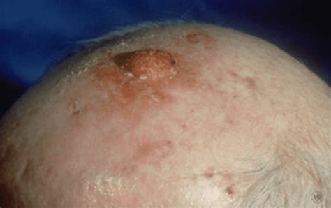 Squamous Cell Carcinoma: Diagnosis, Risks, Treatment & Prevention