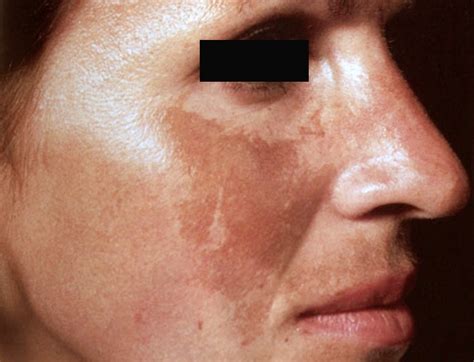 👉 Melasma - Treatment, Pictures, Symptoms, Causes (January 2022)