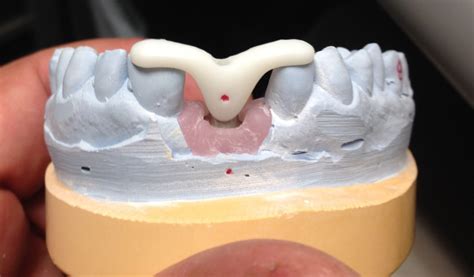 Implant abutment placement jig1 - Robertson Dental Lab