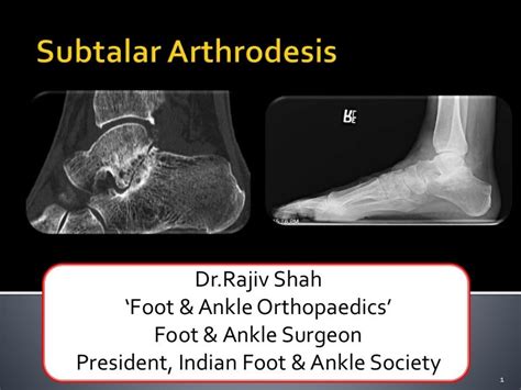 Lecture 35 shah subtalar fusion