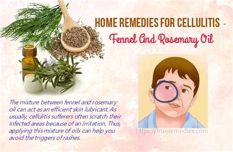 22 Best Home Remedies For Cellulitis Infection On Legs