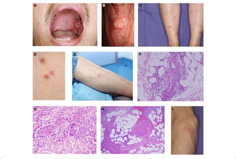 | (A) Oral ulcer on the buccal mucosa with rolled borders and grayish ...