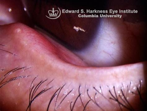 External Hordeolum | Vagelos College of Physicians and Surgeons