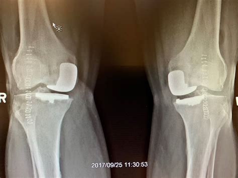 Case Study: Simultaneous bilateral Unicondylar Knee replacement in 67 ...