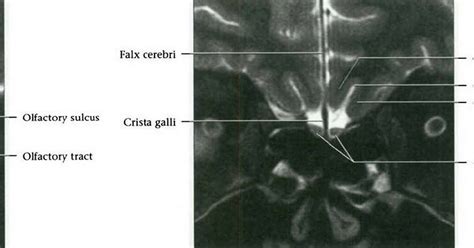 Dr Balaji Anvekar FRCR: Cranial Nerves Normal MRI Anatomy