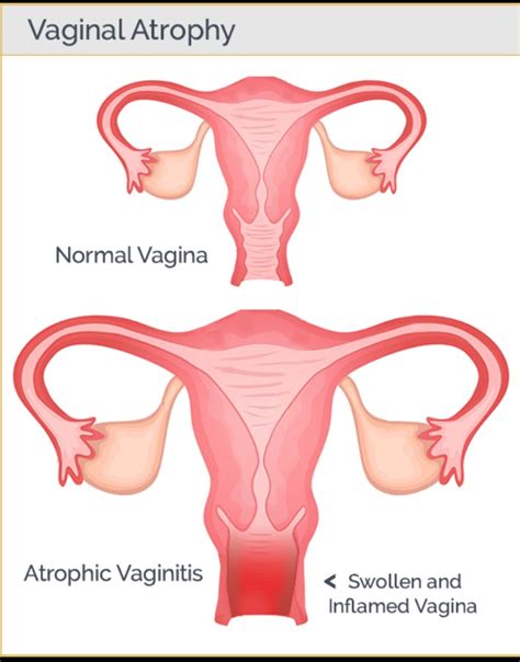 An Overview of Atrophic Vaginitis – Platform | CME