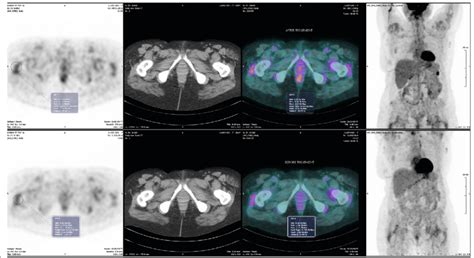 PET scan: upper image: after treatment; lower: before treatment.... | Download Scientific Diagram