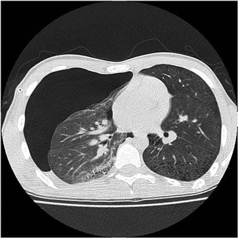 Recurrent pneumothoraces in a 17-year-old man with mixed connective tissue disease | Thorax