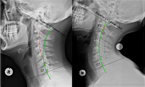 CORRECTION POTENTIAL CERVICAL CURVE IMPROVEMENT | Align Corrective Chiropractic