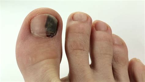 Subungual Hematoma. Bruise Under The Nail Of Big Toe. Injury To The ...