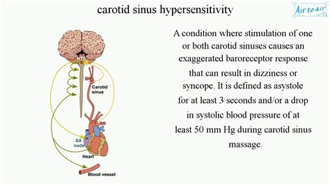 carotid sinus hypersensitivity - YouTube