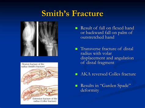 PPT - Common Fracture Eponyms PowerPoint Presentation - ID:5283520