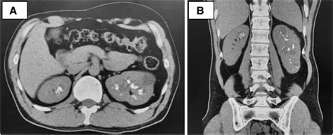 Noncontrast computed tomography findings of medullary sponge kidney.... | Download Scientific ...