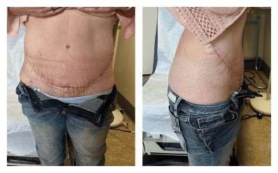 Before & After Tummy Tuck/Panniculectomy Photos - Nevada Surgical