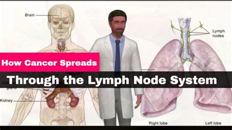 How Cancer Spreads Through The Lymph Node System - Male Health Clinic