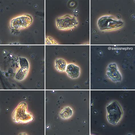 Urine Microscopy with Dr. Florian Buchkremer – GlomCon (pubs)